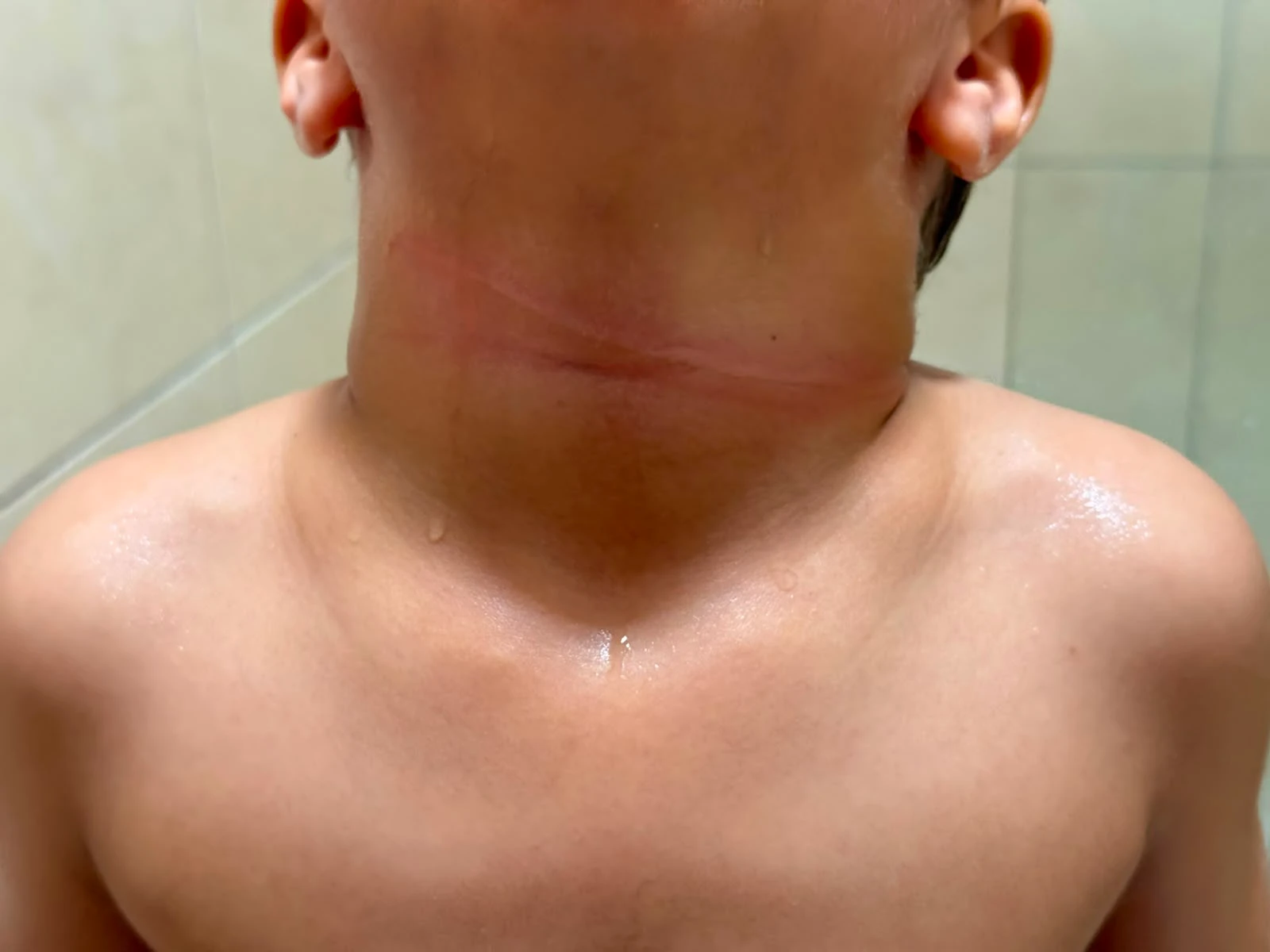 Criança de 4 anos sofre corte no pescoço causado por linha com cerol em Parnaíba
